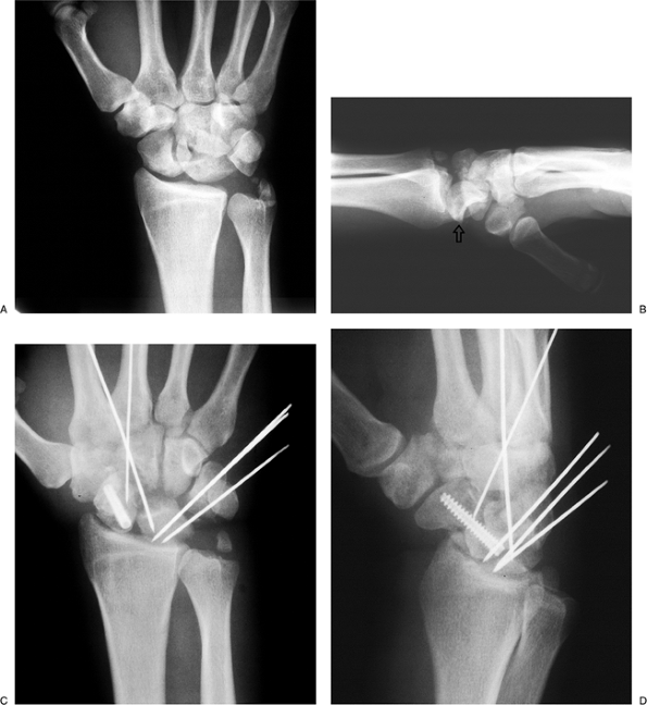 Carpal Instabilities and Fracture-Dislocations of the Carpus - TeachMe ...