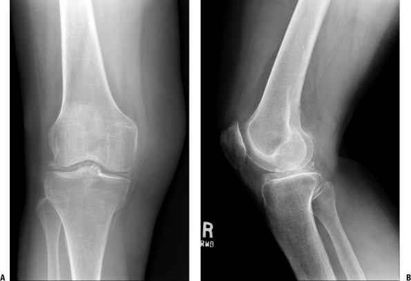 Diarthrodial Joints - TeachMe Orthopedics