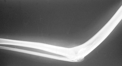 Interposition Arthroplasty of the Elbow - TeachMe Orthopedics