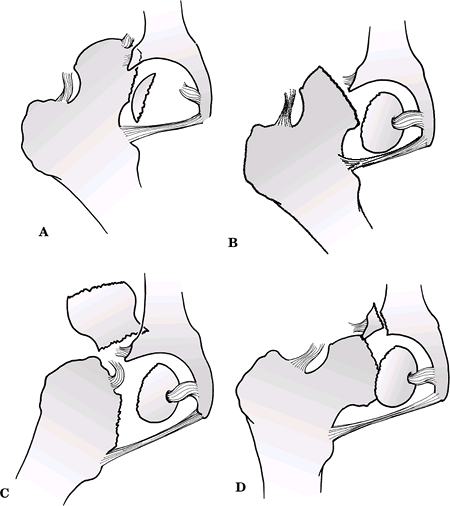 Femoral Head - TeachMe Orthopedics