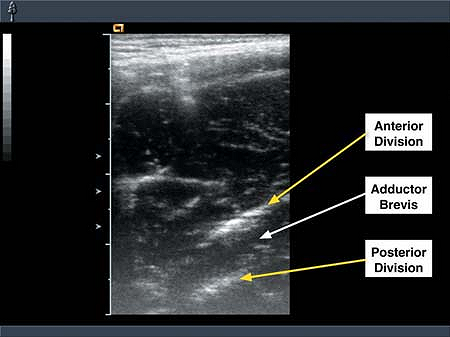 Obturator Nerve Block Ultrasound