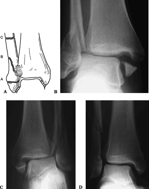 Ankle Fractures Teachme Orthopedics