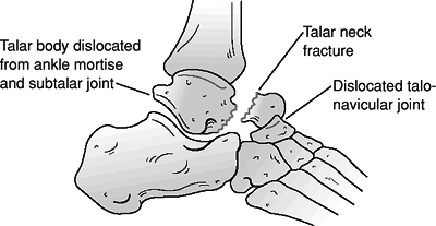 Talus - TeachMe Orthopedics