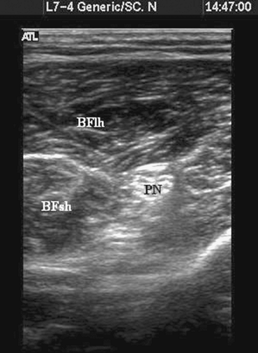 Ultrasound Guided Sciatic Block in the Popliteal Fossa - TeachMe ...