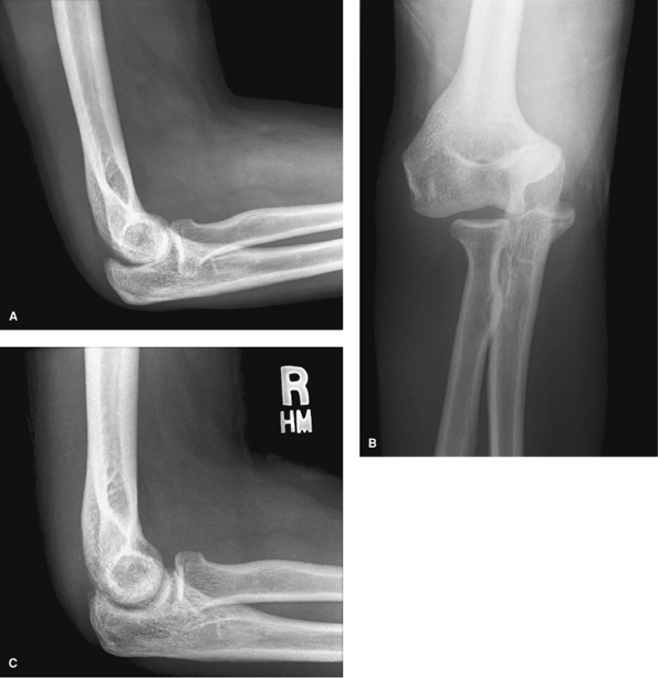 Treatment Of Acute Elbow Dislocations - TeachMe Orthopedics