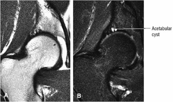 The Hip - TeachMe Orthopedics