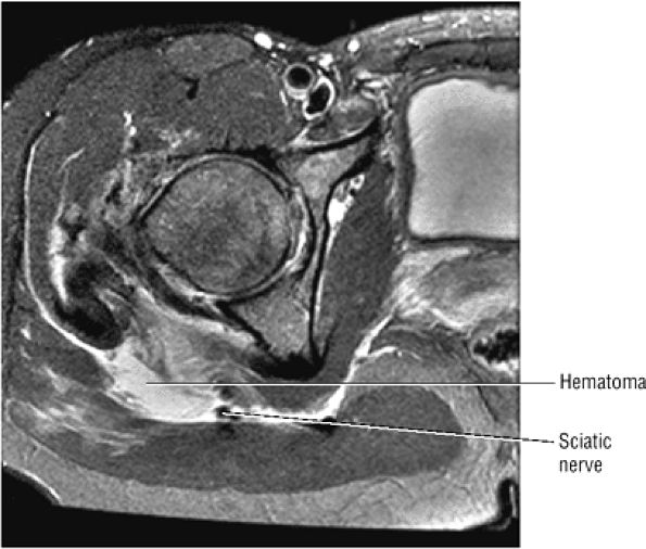 The Hip - TeachMe Orthopedics