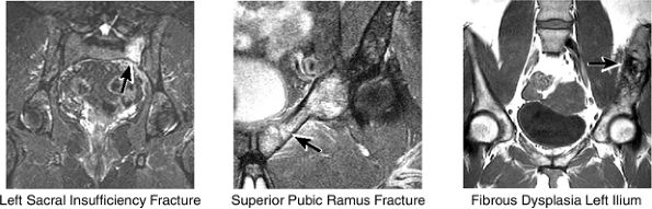 The Hip - TeachMe Orthopedics