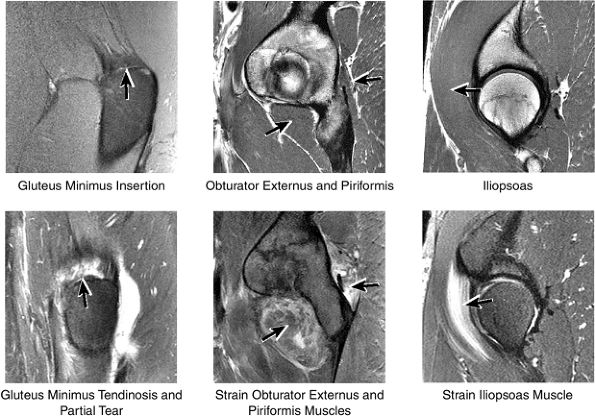 The Hip - TeachMe Orthopedics