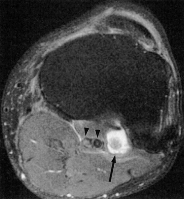 Entrapment Neuropathies Of The Lower Extremity - Teachme Orthopedics