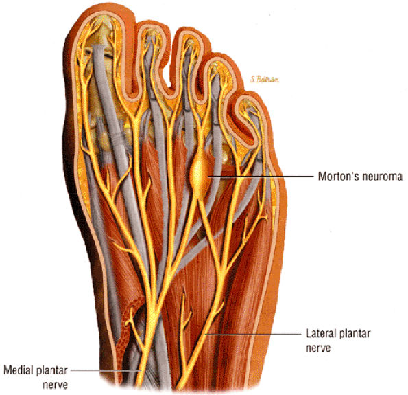 Entrapment Neuropathies of the Lower Extremity - TeachMe Orthopedics