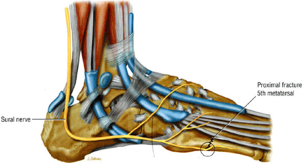 Entrapment Neuropathies of the Lower Extremity - TeachMe Orthopedics