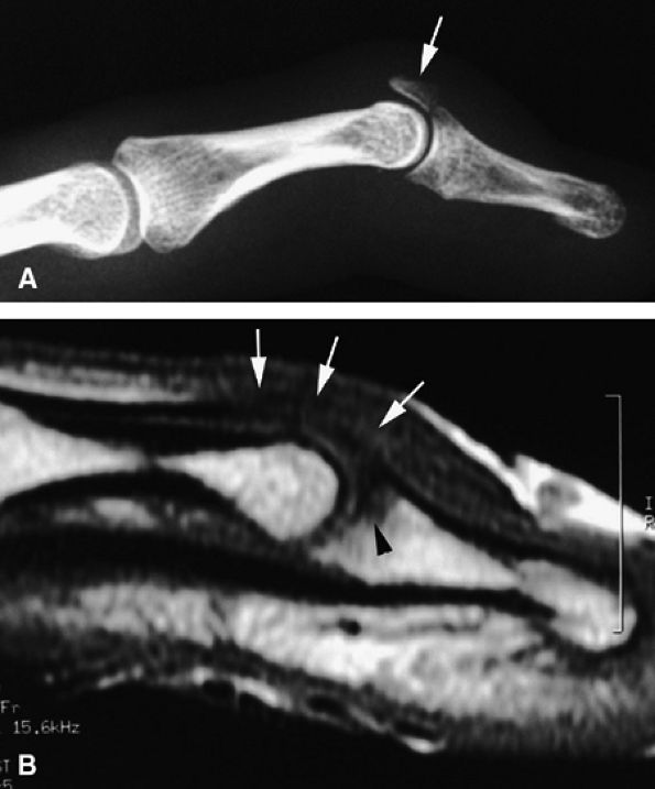 MR Imaging of the Fingers TeachMe Orthopedics