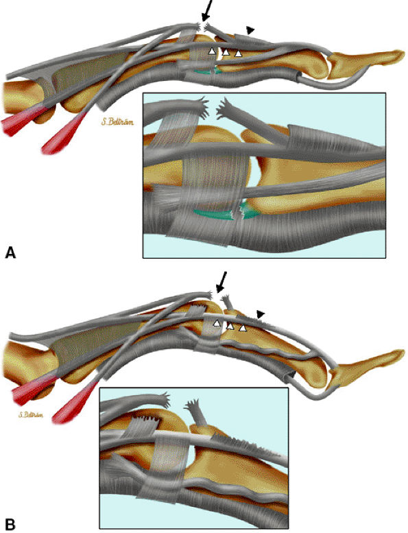 MR Imaging of the Fingers - TeachMe Orthopedics