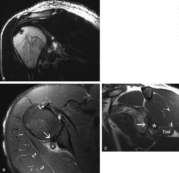 Entrapment Neuropathies Of The Upper Extremity - TeachMe Orthopedics