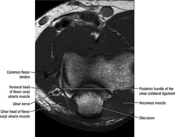 Entrapment Neuropathies of the Upper Extremity - TeachMe Orthopedics