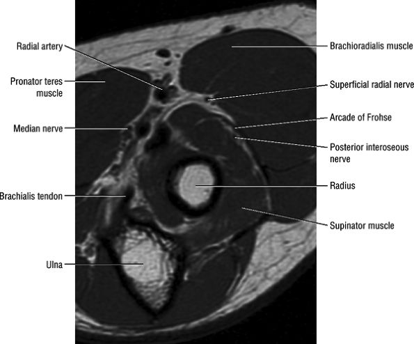 Entrapment Neuropathies of the Upper Extremity - TeachMe Orthopedics