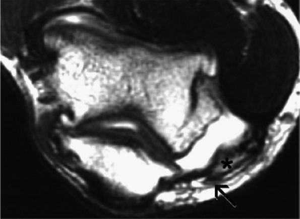 Entrapment Neuropathies Of The Upper Extremity - TeachMe Orthopedics