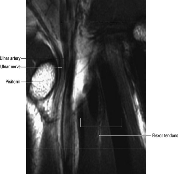 Entrapment Neuropathies Of The Upper Extremity - TeachMe Orthopedics