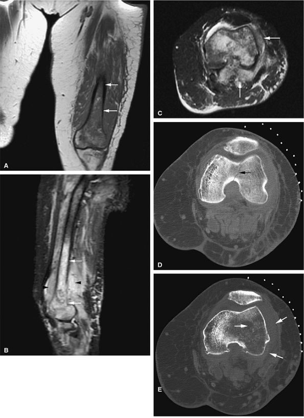 Marrow Imaging - Teachme Orthopedics