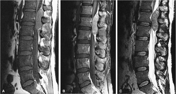 Marrow Imaging - TeachMe Orthopedics