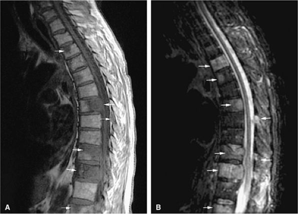 Marrow Imaging - TeachMe Orthopedics