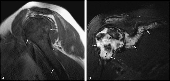 Marrow Imaging - TeachMe Orthopedics