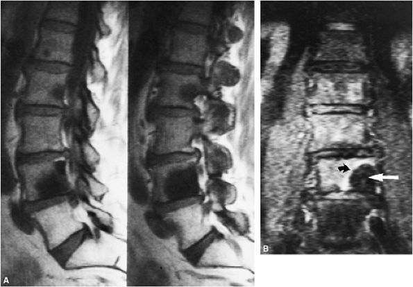 Marrow Imaging - TeachMe Orthopedics