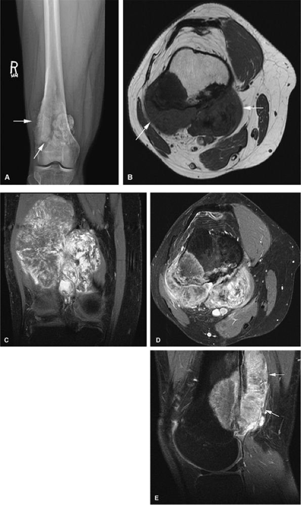 Bone and Soft-Tissue Tumors - TeachMe Orthopedics