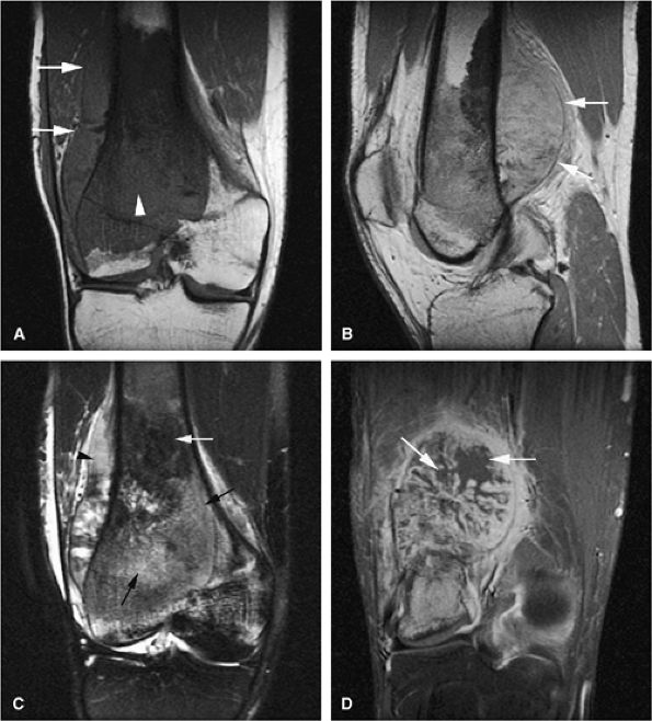 Bone and Soft-Tissue Tumors - TeachMe Orthopedics