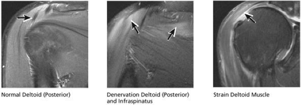 The Shoulder - TeachMe Orthopedics