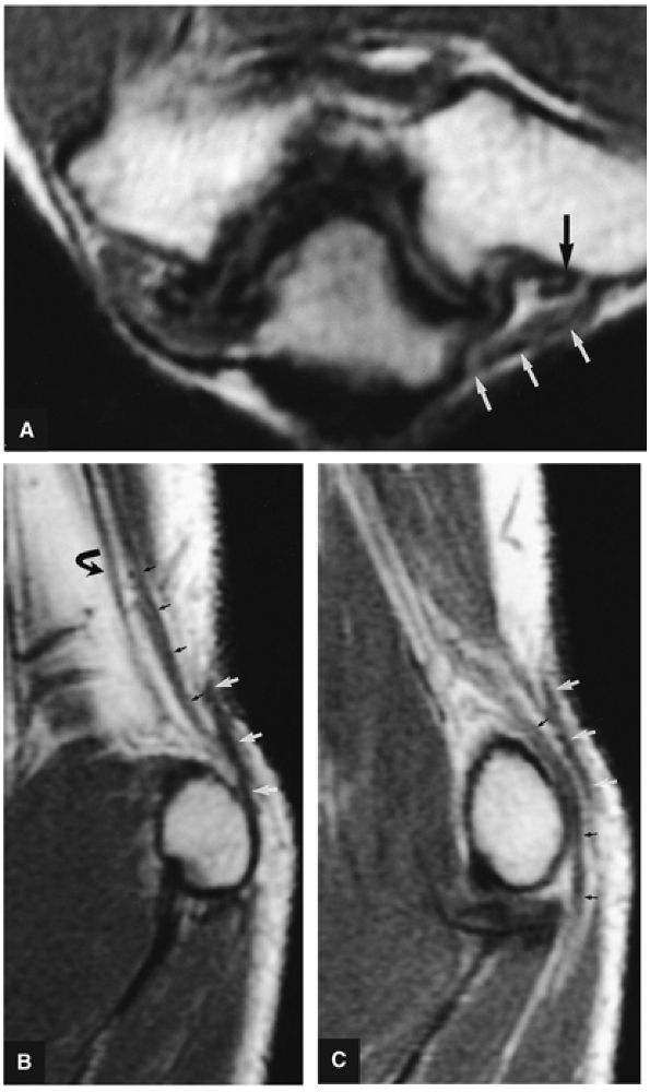 The Elbow - TeachMe Orthopedics