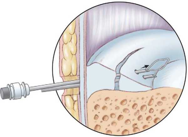 CHAPTER 45 – - TeachMe Orthopedics